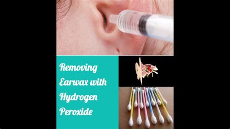 How To Use Hydrogen Peroxide Eardrop To Remove Impacted Ear Wax Buildup