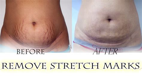 Get Rid Of Stretch Marks In 30 Days Stretch Marks Removal Simple