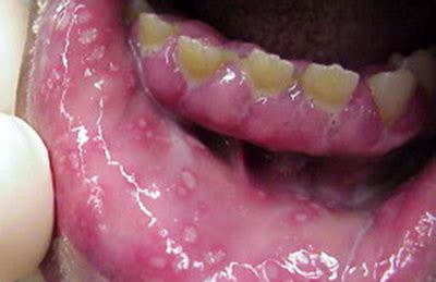 By using the treatments in this article, you can reduce the severity and pain of mouth sores. Cold sores: Signs and symptoms