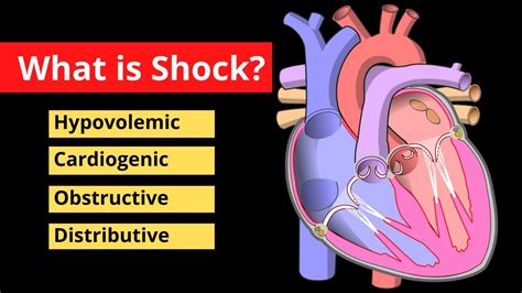 Shock Explained In 120 Seconds Treatment Symptoms Causes Video