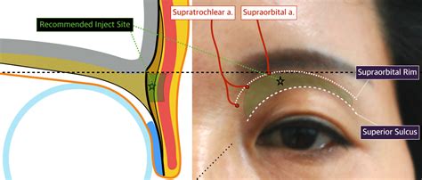 3 1 Upper Face Sunken Eyelid Pretarsal Fullness D PS Upper