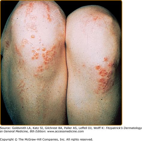 Dermatitis Herpetiformis Causes Treatment And Pictures Dermatitis My