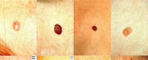 5 Tips For Checking Your Moles For Skin Cancer Sciencealert