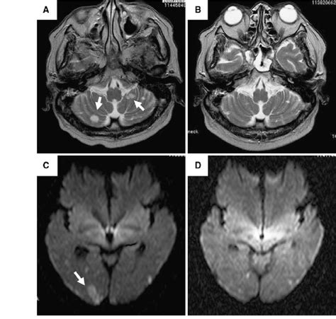 T2 Weighted Axial Magnetic Resonance Imaging Mri Of The Brain