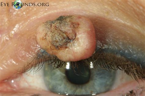 Malignant Lesions Of The External Periocular Tissues Tutorial