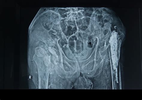 Hip Fractures Surgery In Ahmedabad Dr Rachit Sheth