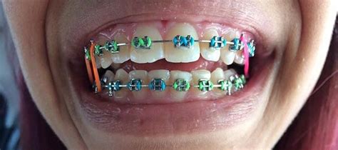 Braces Colors That Look Good Together