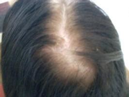 Sometimes, it's triggered by changes in your hormone levels and a genetic sensitivity to certain hormones. Dr. Doris Day's Tips for Treating Thinning Hair and My ...