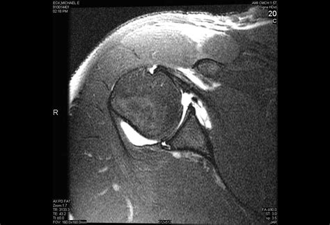 Arthroscopic Repair Of Posterior Labral Tear With Paralabral Cyst