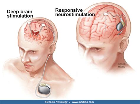 Neuromodulation MedLink Neurology
