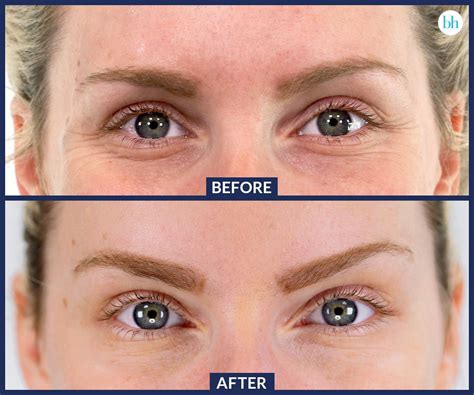 Botox Before And After Botox Eyes Botox Before And After Eyebrow