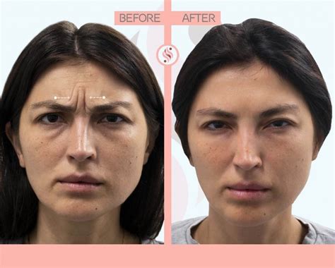 Effective Dysport Injections In New York Skinly Aesthetics