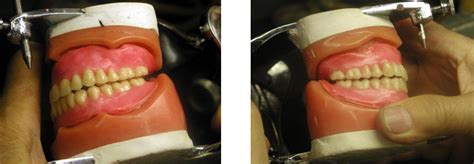 Balanced Occlusions | Flexite Flexible Partial Dentures Are Unbreakable