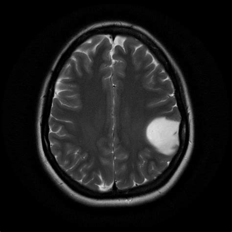 Brain Tumor Cerebellar Astrocytoma Childhood Pictures