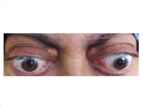 Is a bulging of the eye anteriorly out of the orbit. exophthalmos - Liberal Dictionary
