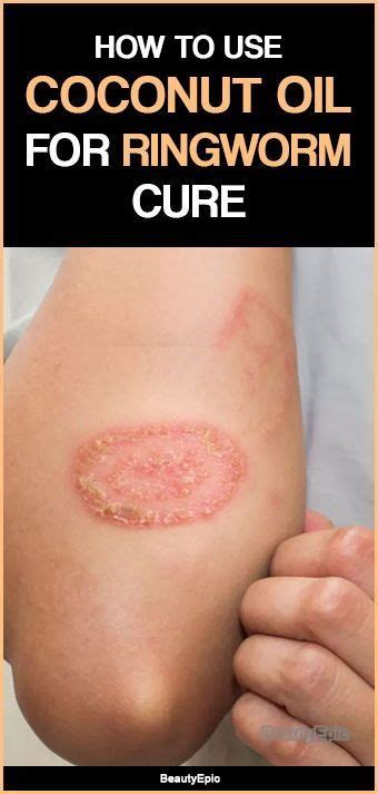 How To Use Coconut Oil For Ringworm Cure Ringworm Cure Home