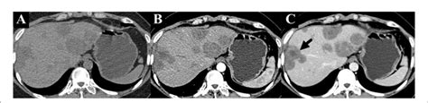 Figure E Unenhanced Ct Scan Showed Multiple Intrahepatic Lesions A