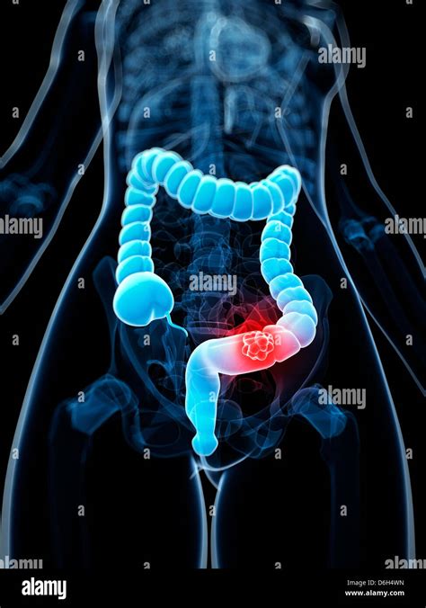 Colon Cancer Hi Res Stock Photography And Images Alamy