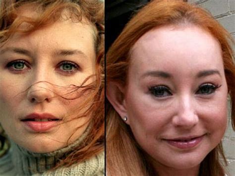 Tori Amos Plastic Surgery Disaster Before After Photos