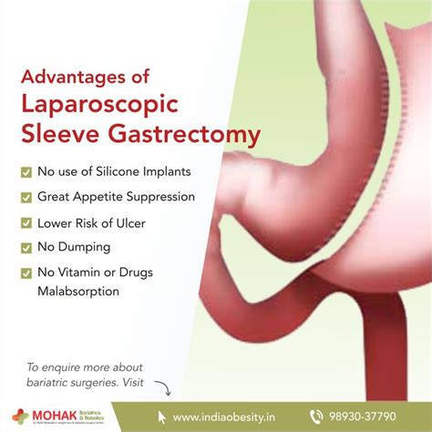 Advantages Of Laparoscopic Sleeve Gastrectomy Bariatric Surgeon