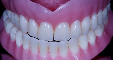 Dentaduras Postizas Tipos Clínica Dental En Dos Hermanas