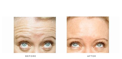 Anti Wrinkle Injections Before And Afters Infinity Clinic