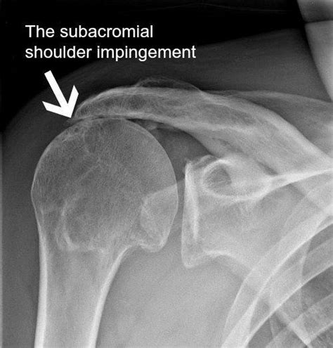 Subacromial Shoulder Impingement Physiocure