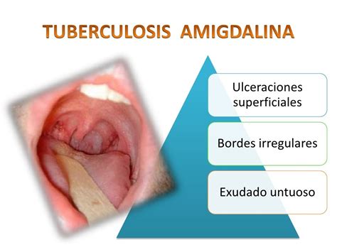 Anginas De Las Enfermedades Infectocontagiosas