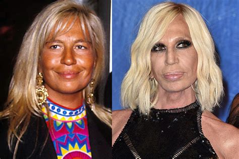 Le Star Prima E Dopo La Chirurgia La Trasformazione Di Donatella Versace