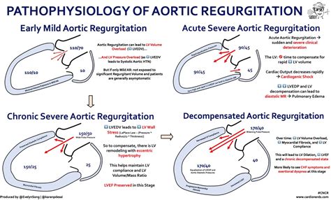 Aortic Regurgitation Pathophysiology