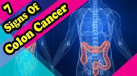 7 Signs And Symptoms Of Colon Cancer Youtube