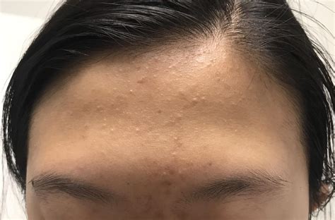 Skin Concern Prominent Fine Lines And Small White Bumps R