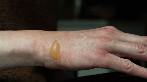 Close Up Of A Woman S Hand With A Blister From A Boiled Water Burn