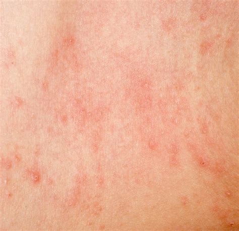 Itchy Rash On Stomach Yeast Infection Rash On Stomach Guide Some