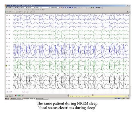 Rolandic Epilepsy With Atypical Features Progressive