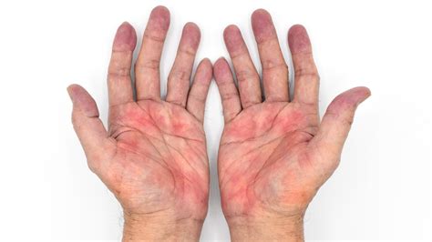 What It Really Means When Your Palms Turn Red