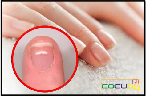 Por que salen manchas blancas en las uñas Cocupo