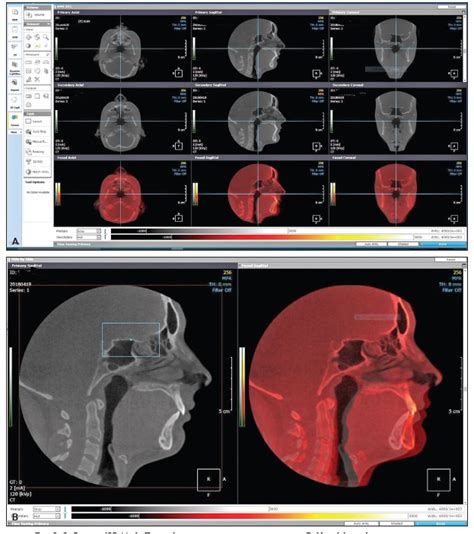 Voxel Size In Cbct Furcation Lesions Were Prepared In Molar Teeth