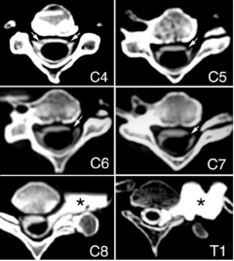 Computed Tomography Myelography Images Obtained In A Patient With An