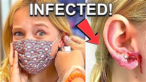 Infection Disaster I Got A New Ear Piercing And This Happened Gross Warning Youtube