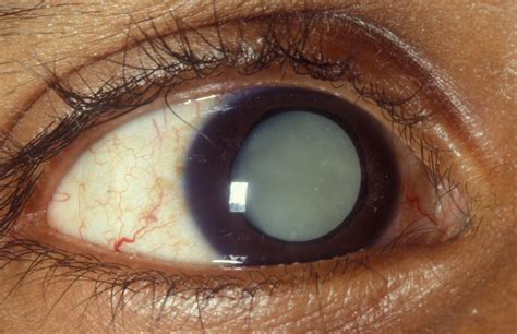 Cataract Surgery What Can One Expect Before During And After The