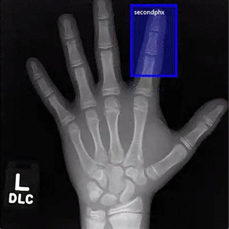 Index Finger Labeling Tool On A Posteroanterior Hand Radiograph Of A