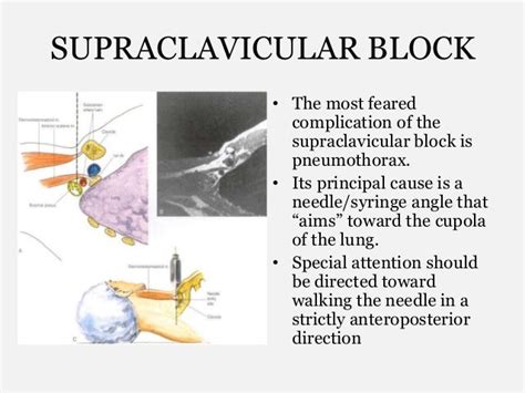 Brachial Plexus Blocks