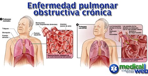 D A De La Enfermedad Pulmonar Obstructiva Cr Nica Epoc