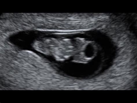 Condiciones del presente contrato, pudiendo solicitar y obtener copia firmada por embryo live. Sonoembryology: Live Embryo at Carnegie Stage 16 - YouTube