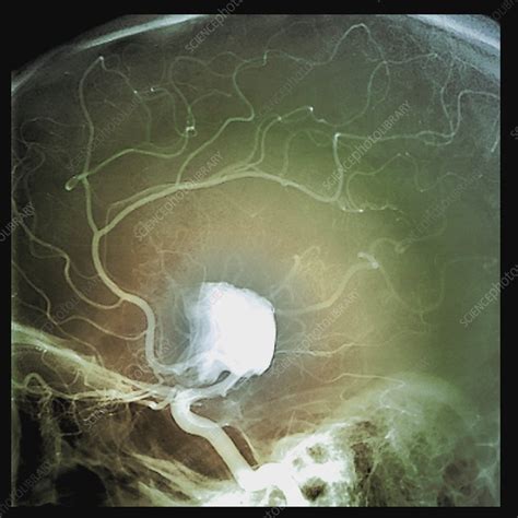 Cerebral Aneurysm Angiogram Stock Image C0388802 Science Photo