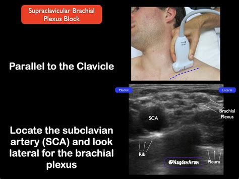 Supraclavicular Brachial Plexus Highland EM Ultrasound Fueled Pain Management