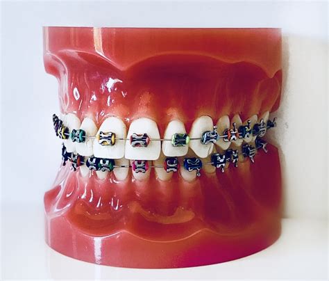 Red Bank Orthodontics Traditional Braces