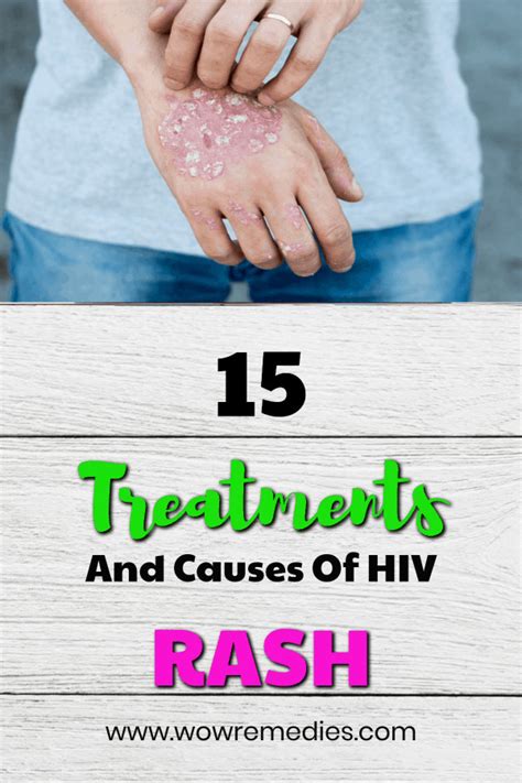 Hiv Rash Symptoms Characteristics Pictures And Treatm Vrogue Co