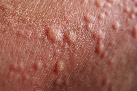 Bumps On Skin Skin Mysteries Explained Readers Digest
